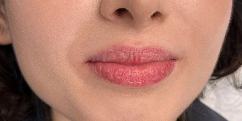 Коррекция губ, препарат Stylage S