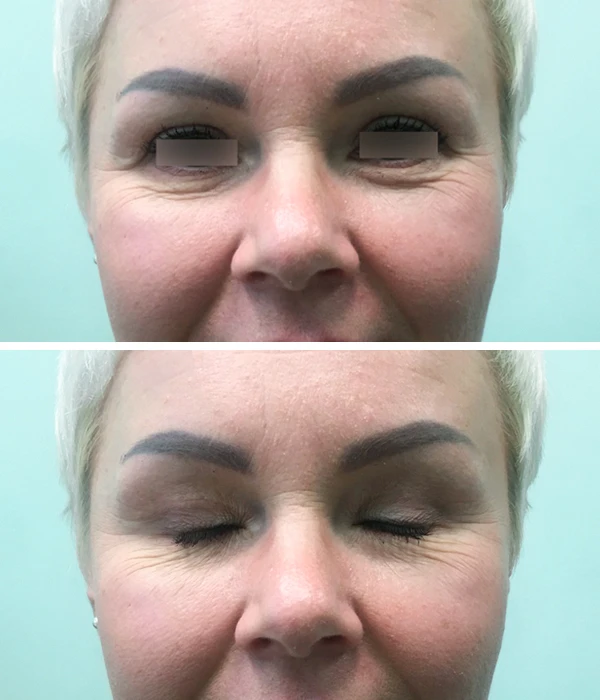 Пластика верхних век: фото после