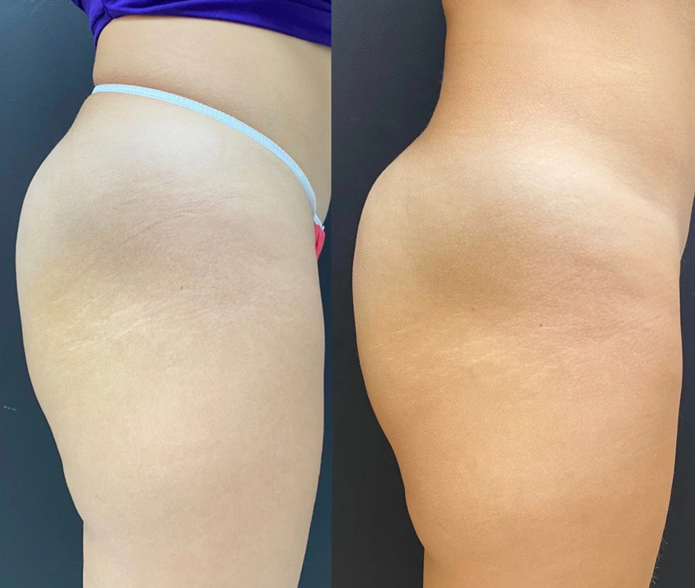 Sculptra. Клинический случай