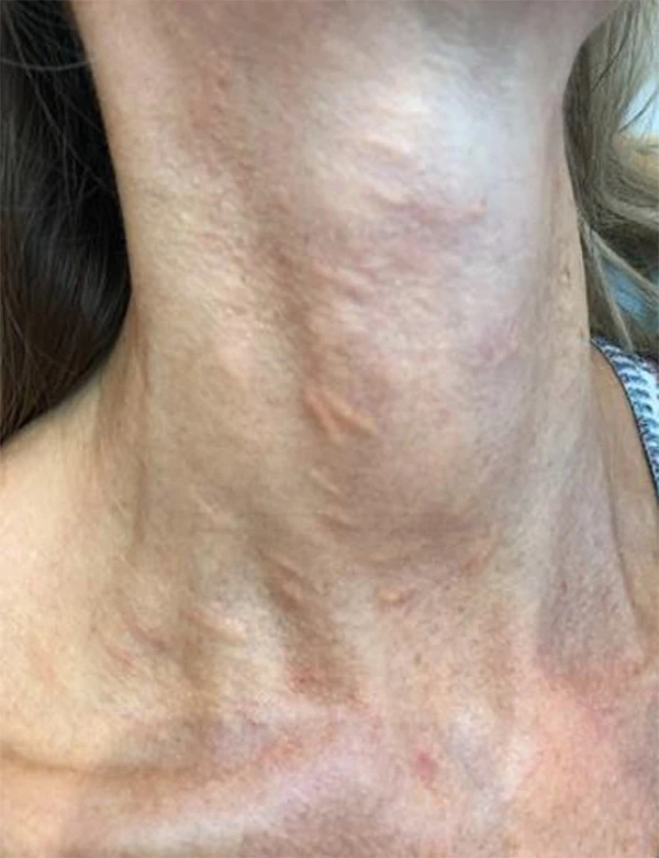 Через 1 месяц после мезотерапии