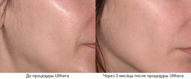 аппарат ультразвукового лифтинга, ulthera system до и после