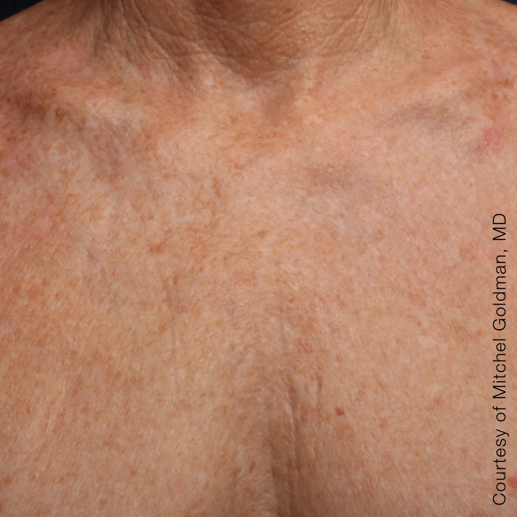 Ultherapy После