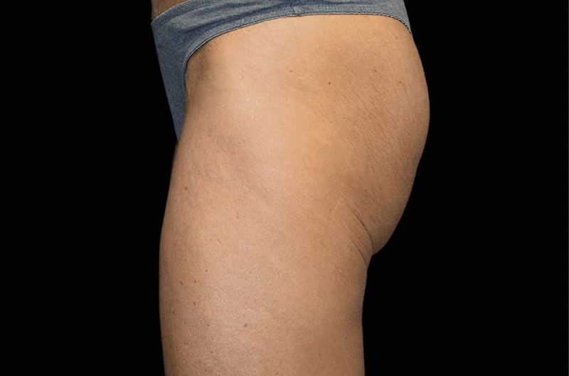 Фото до процедур на аппарате EMSCULPT