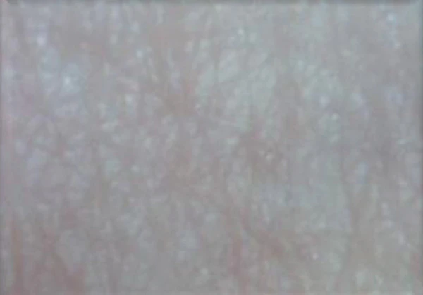 Комбинированный протокол: пилинг и биоревитализант