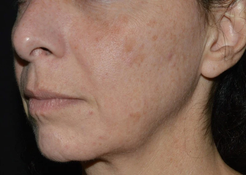 LaseMD Ultra // До процедуры