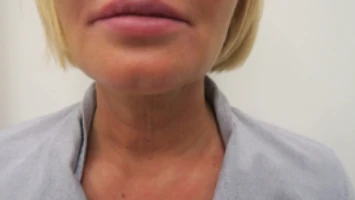 Радиочастотный лифтинг Scarlet RF, фото до