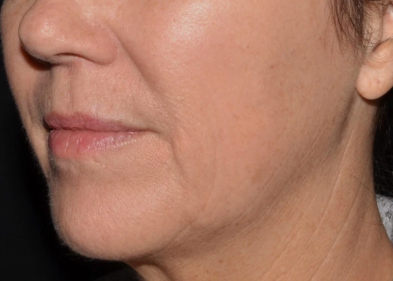 LaseMD Ultra // После процедуры