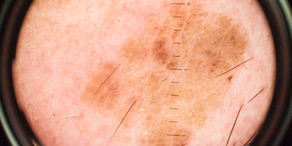 Международный день профилактики меланомы