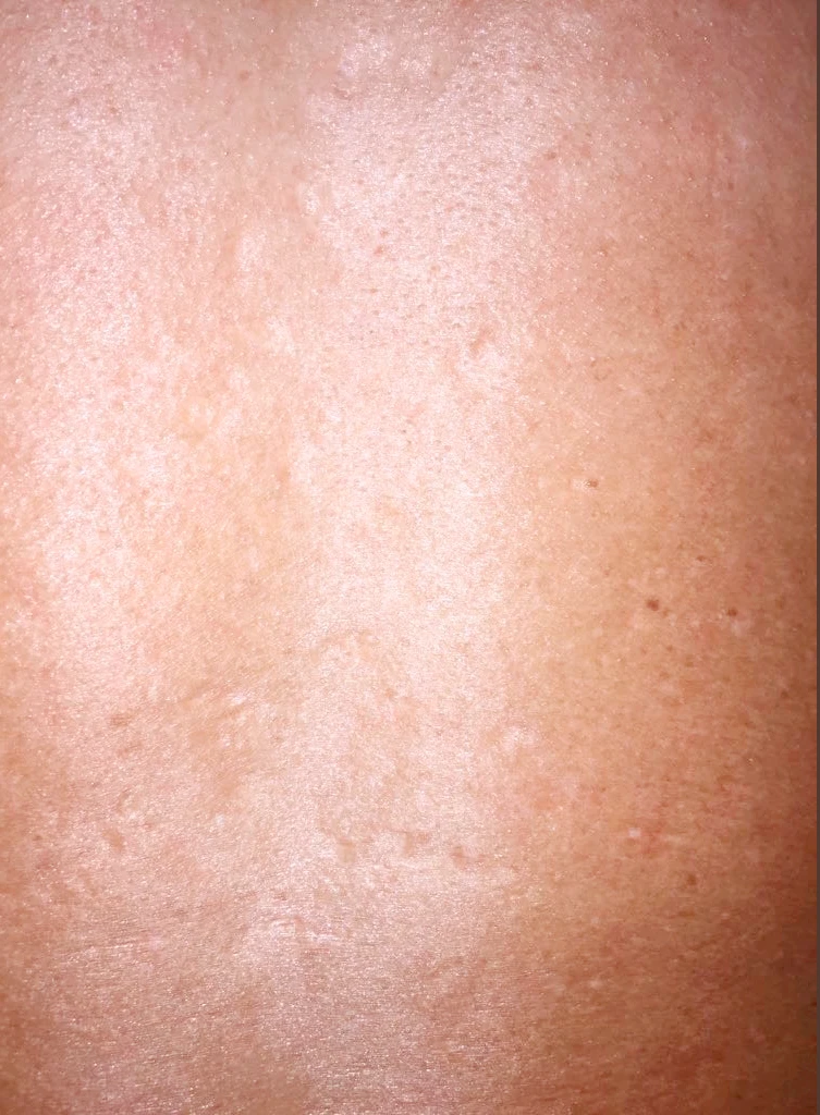 Радиочастотный лифтинг Scarlet RF, фото до