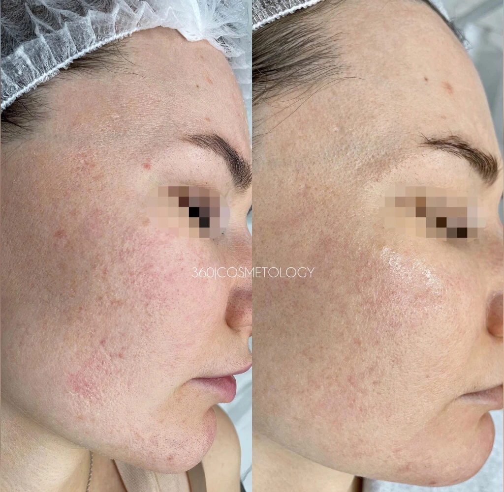 терапия HELEO4™