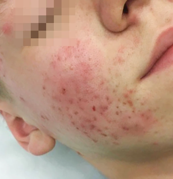 BBL BroadBand Light Acne