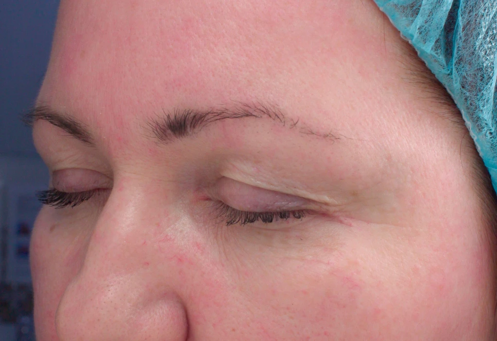 Применение Ultherapy