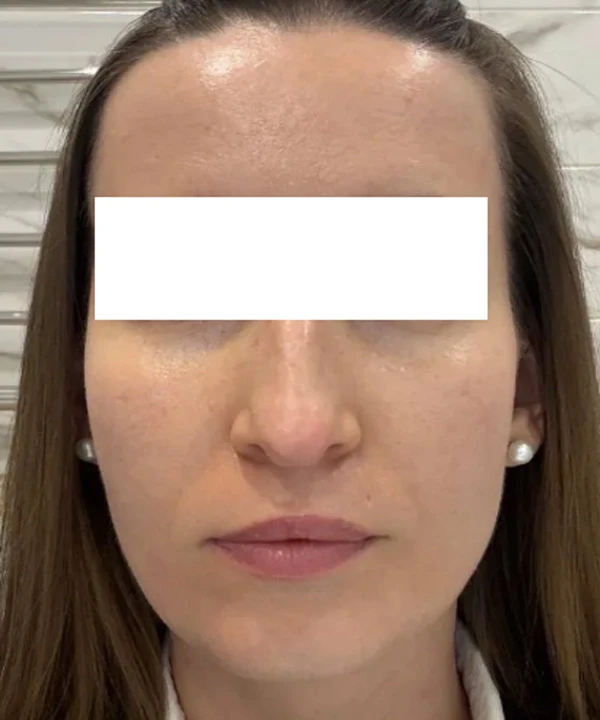 Alma Hybrid, фото после