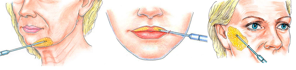 Что такое липофилинг