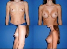 Пример груди класса 3