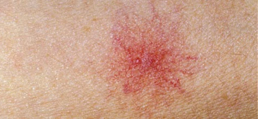 Сосудистые звездочки 