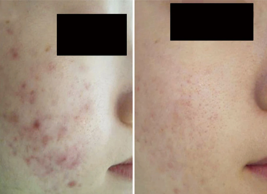 До и после Scarlet RF