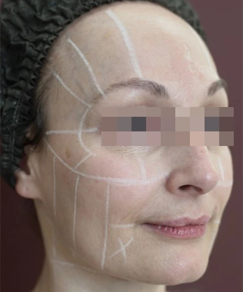 Протокол Альтера-терапия