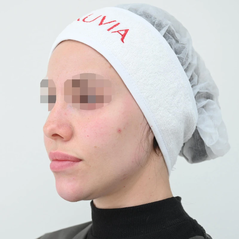 Процедура Fresh&Lift, фото после