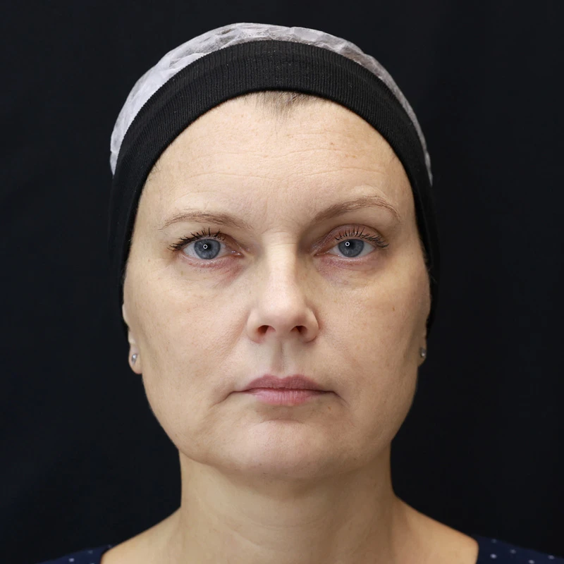 Bioregen Фото после