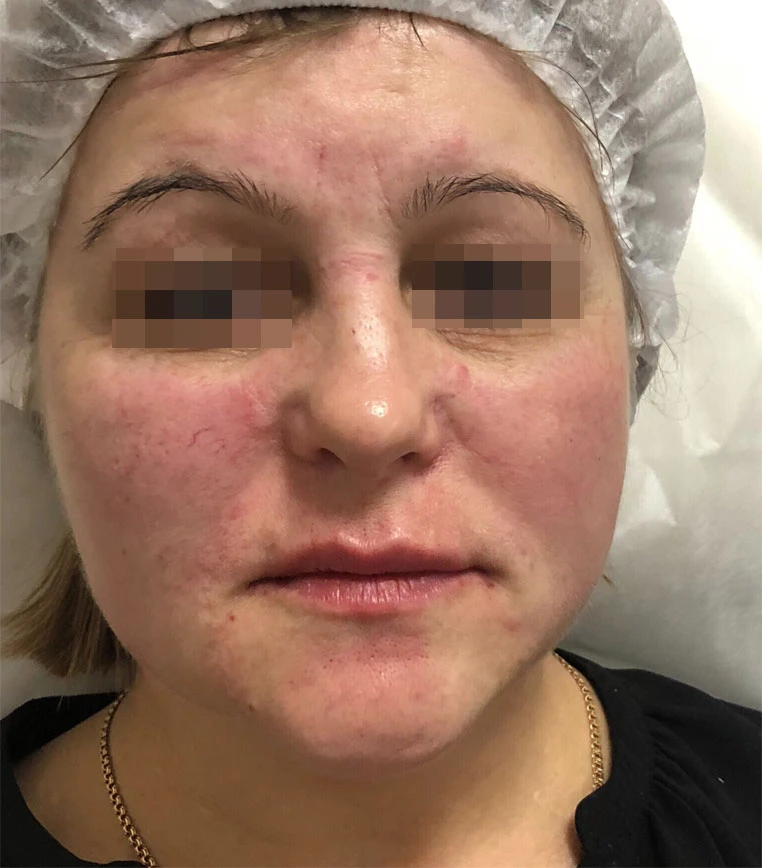 Сочетанное применение Ultherapy, филлерной и БТА коррекции