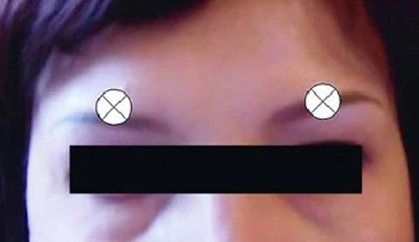 Область возможной диффузии в леваторы верхнего века