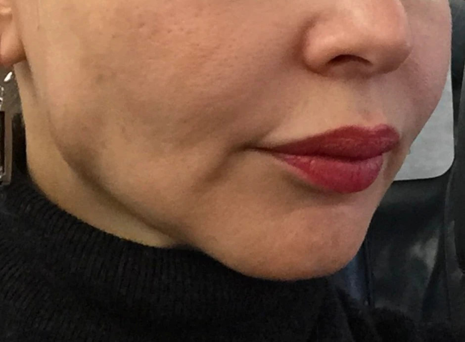 Ксеомин, Жевательная мышца