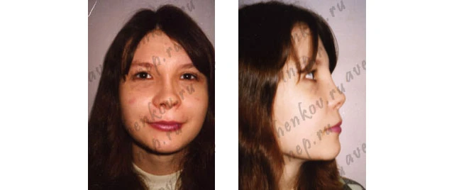 полный дефект спинки носа