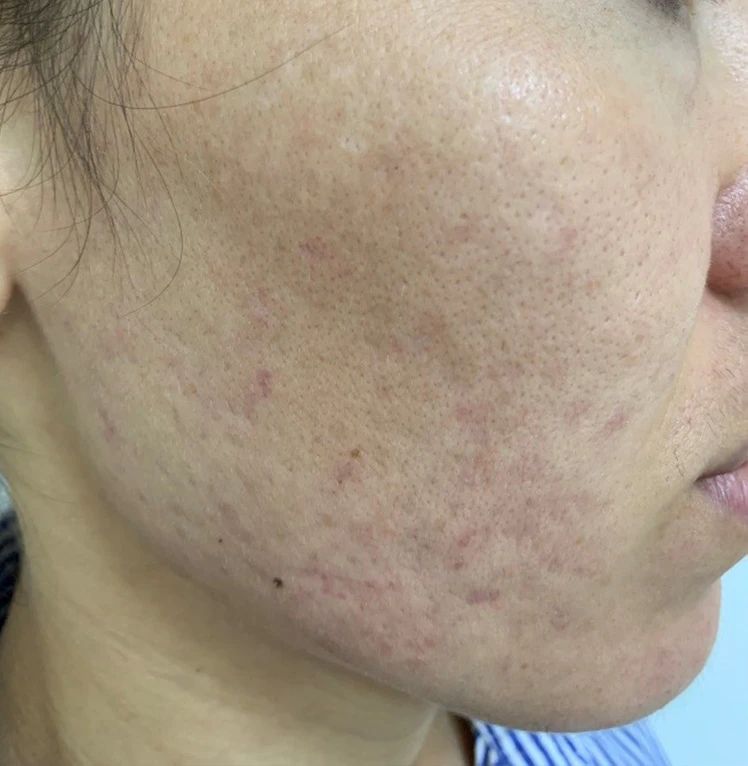 Пилинги Hyalual Peel фото после