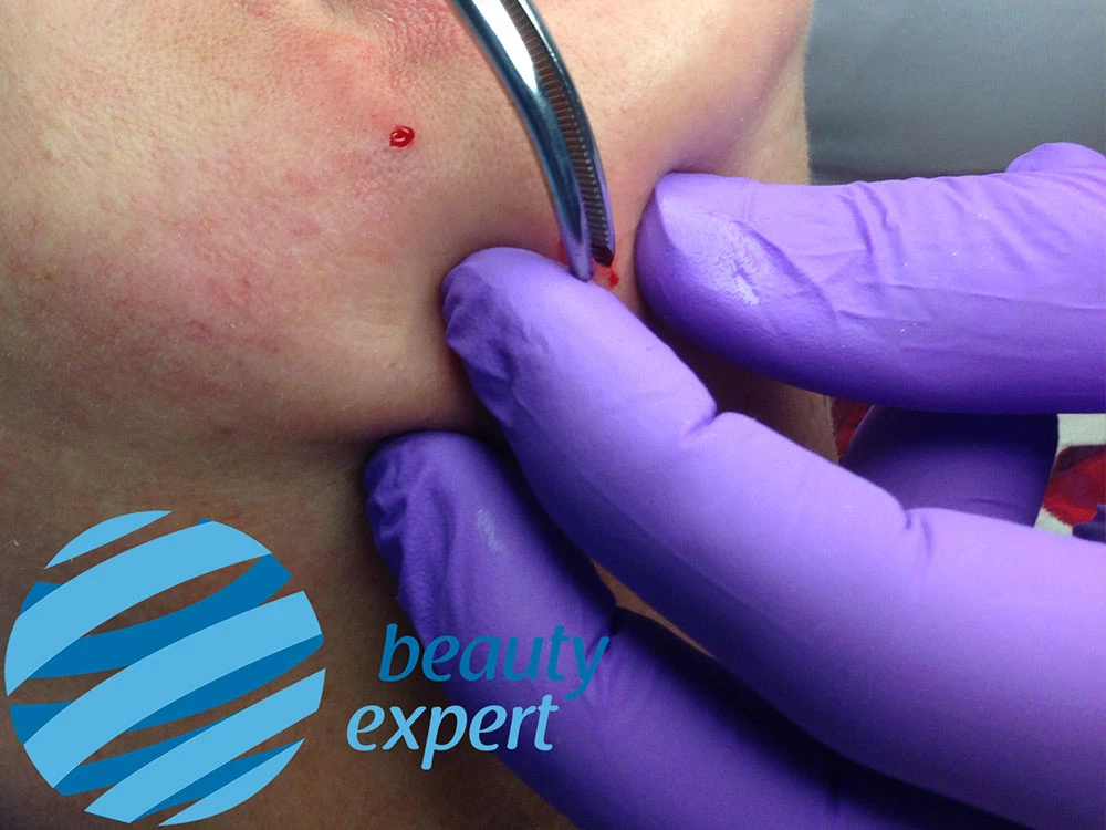 Извлечение нити