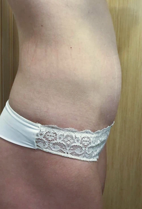 коррекция на аппарате Ultraformer, фото до