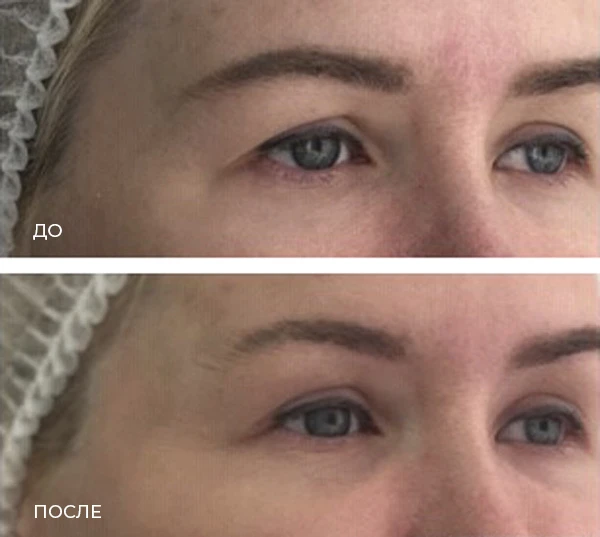 заднетемпоральный лифтинг