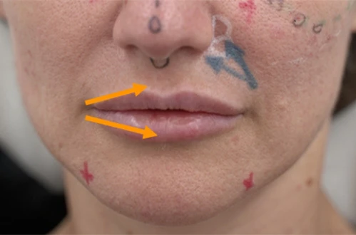 Коррекция препаратом Belotero