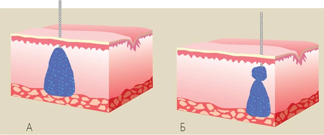  коррекция носослезной борозды, носослезная борозда пластика