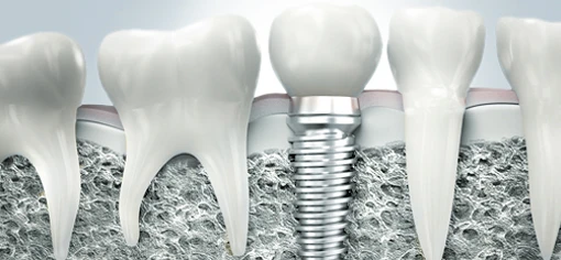 Имплантация зубов 