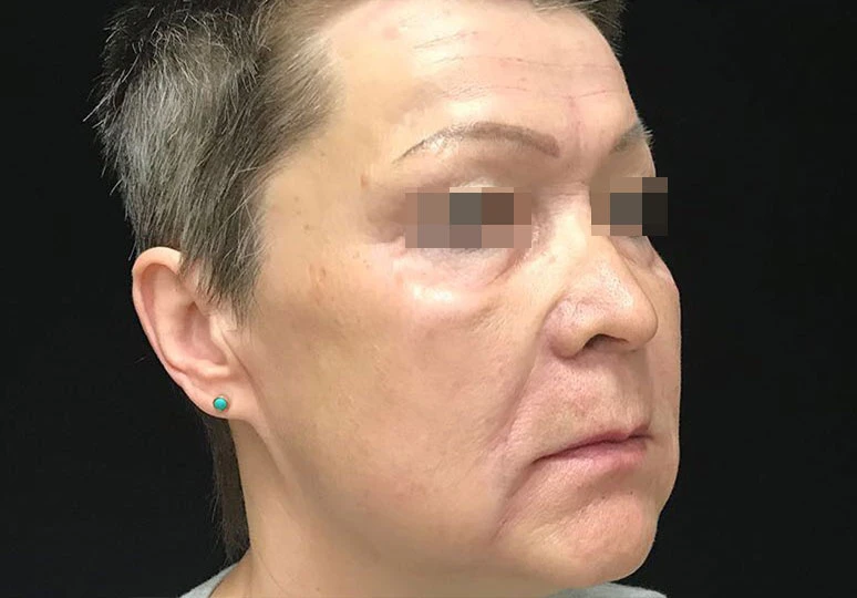 Сочетанное применение Ultherapy и инъекционной коррекции