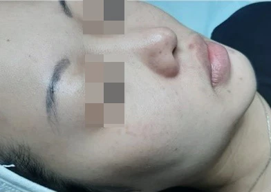 Acless spot peel