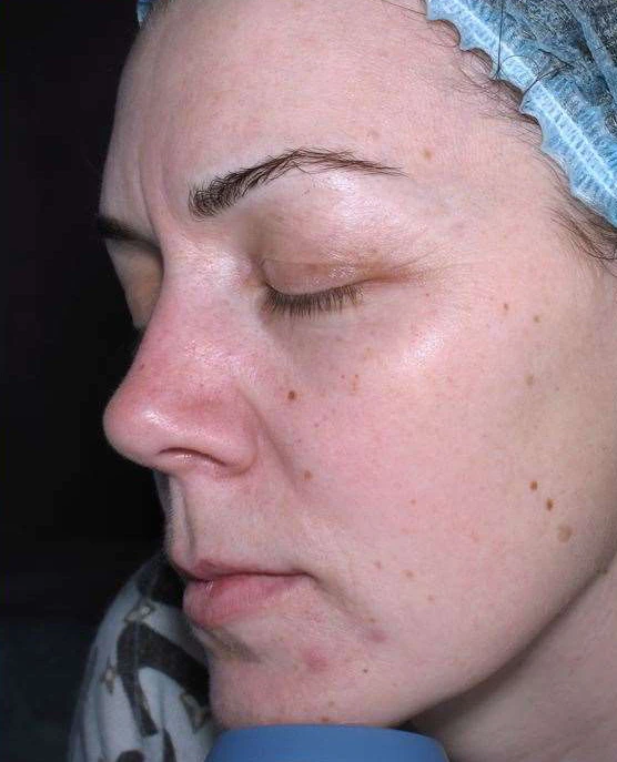 Фото до проведения процедуры HELEO4