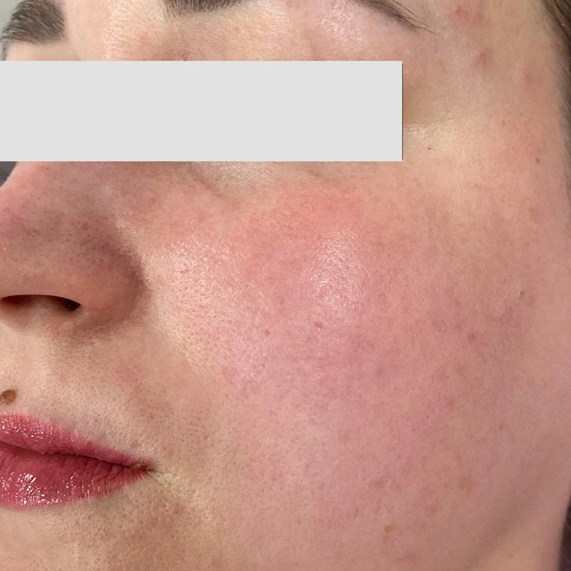 Водородный гидропилинг Hydra Touch H2