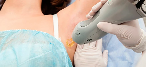 Лазер в косметологии