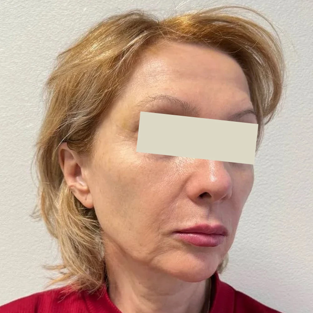 Омоложение лица за одну процедуру