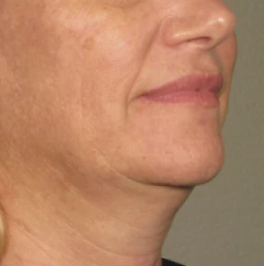 Фото до процедуры Ultherapy