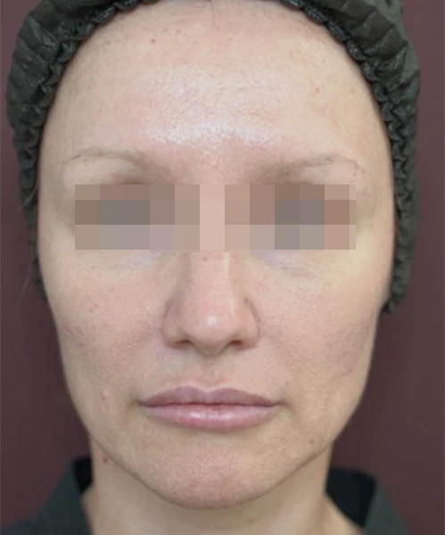 Пациент 3 до процедуры