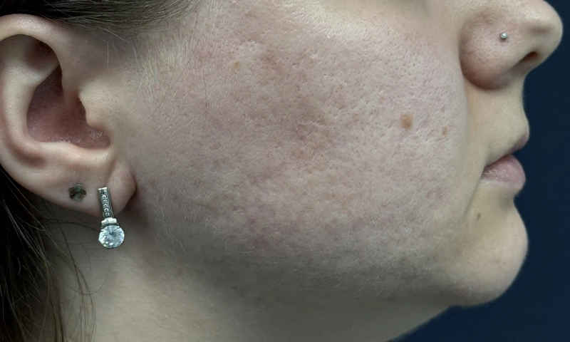 Комбинация пилинга B-Twin System и PRP Cellenis