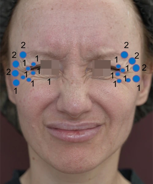 Коррекция препаратом Belotero