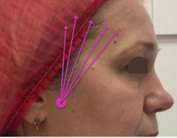 заднетемпоральный лифтинг, разметка