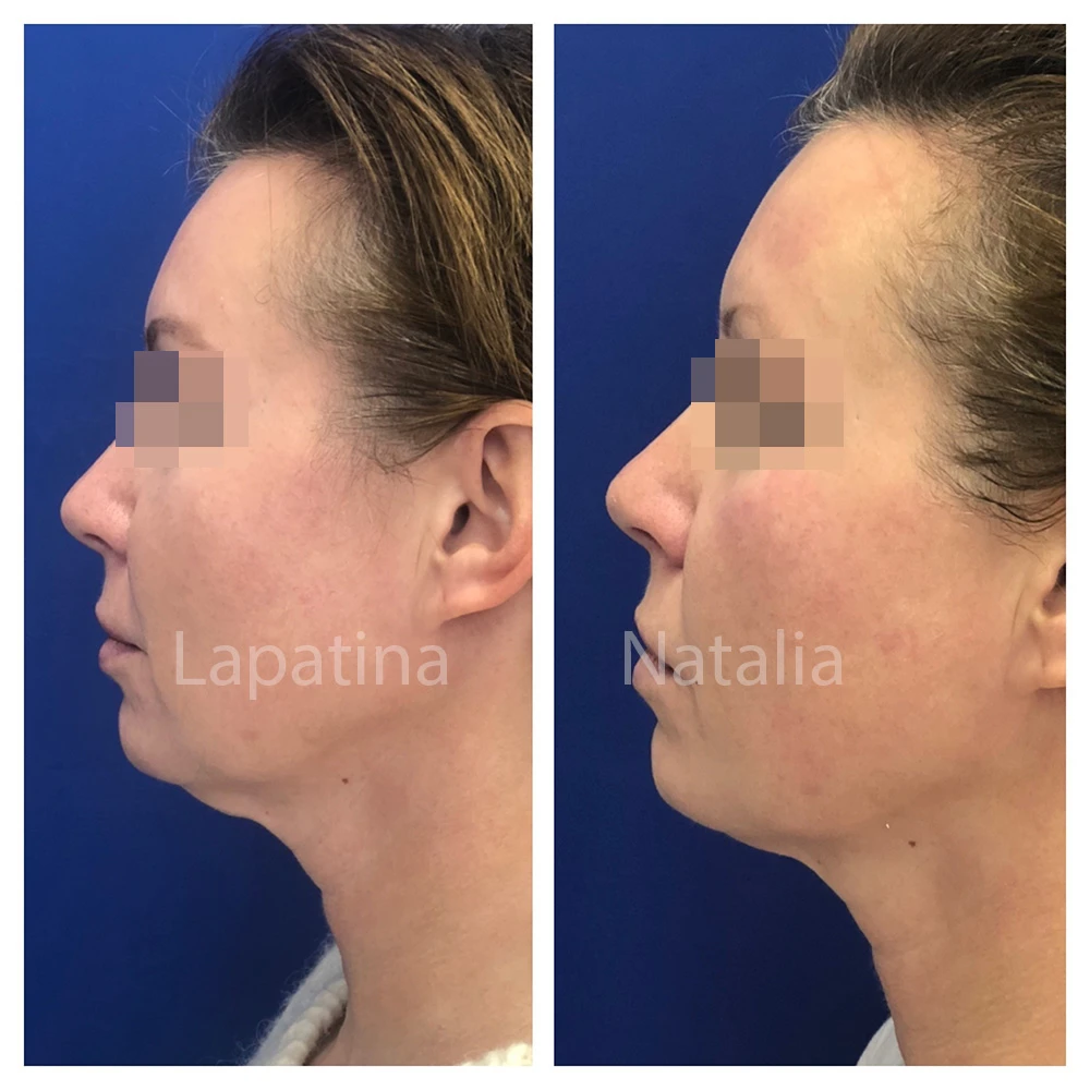 Альтера-терапия, Ultherapy, фото до и после