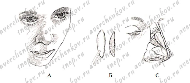 полный дефект спинки носа