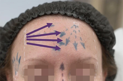 Коррекция препаратом Belotero