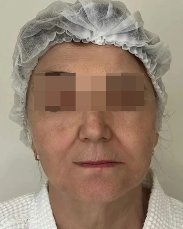 ALMA HYBRID, фото пациента после